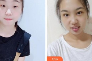 武漢佰視達(dá)眼科門(mén)診部顧兢兢整形價(jià)格表附切開(kāi)雙眼皮案例展示