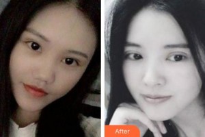 武漢佰視達(dá)眼科門診部林可劼整形價格表附切開雙眼皮案例展示