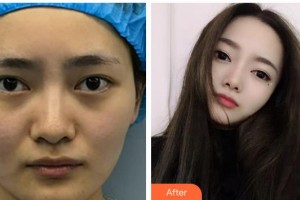 武漢佰視達(dá)眼科門診部趙青華整形價格表附眼部修復(fù)案例展示