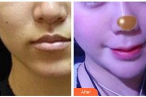 黃石市中心醫(yī)院整形外科步長(zhǎng)龍整形價(jià)格表附埋線(xiàn)提升案例展示