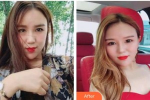 黃石市第五醫(yī)院整形外科可國(guó)安整形價(jià)格表附超聲提拉案例展示