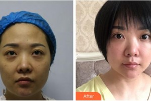 黃石市第五醫(yī)院整形外科黃曉明整形價(jià)格表附埋線(xiàn)提升案例展示