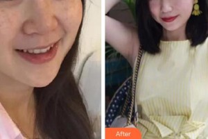 黃石市第五醫(yī)院整形外科韓斌整形價(jià)格表附激光美膚激光案例展示