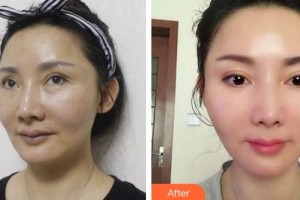 黃石市第五醫(yī)院整形外科翁志勇整形價(jià)格表附超聲提拉案例展示