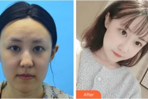 黃石市中心醫(yī)院整形外科王政祥整形價(jià)格表附埋線(xiàn)提升案例展示