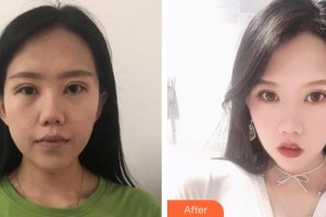 黃石中愛(ài)醫(yī)療美容門(mén)診部祁向峰整形價(jià)格表附埋線(xiàn)提升案例展示