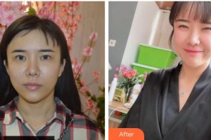 黃石市中心醫(yī)院整形外科陳杰整形價(jià)格表附埋線(xiàn)提升案例展示