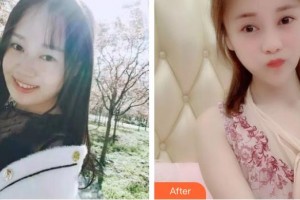 黃石市中心醫(yī)院整形外科沈健整形價(jià)格表附埋線(xiàn)提升案例展示