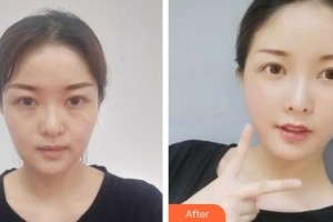 黃石華中?？滇t(yī)院（華中.華美）曹英武整形價(jià)格表附埋線(xiàn)提升案例展示