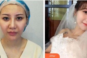 黃石市第五醫(yī)院整形外科陳正華整形價(jià)格表附埋線(xiàn)提升案例展示