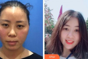 黃石美亞醫(yī)療美容門(mén)診部張明雙整形價(jià)格表附埋線(xiàn)提升案例展示