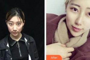 黃石華中福康醫(yī)院（華中.華美）余秋芬整形價(jià)格表附埋線提升案例展示