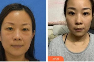 黃石愛爾眼科醫(yī)院喻杰整形價(jià)格表附激光去眼袋案例展示