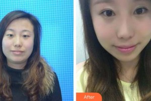 黃石愛(ài)爾眼科醫(yī)院吳海政整形價(jià)格表附眼部綜合案例展示