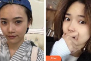 黃石愛(ài)爾眼科醫(yī)院朱劍整形價(jià)格表附內(nèi)切祛眼袋案例展示