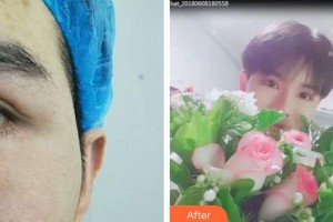 黃石愛(ài)爾眼科醫(yī)院柯國(guó)梁整形價(jià)格表附眼部綜合案例展示