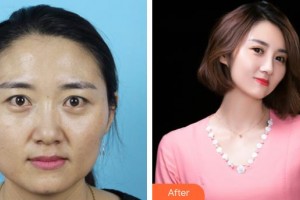 黃石愛(ài)爾眼科醫(yī)院吳湘整形價(jià)格表附切開(kāi)雙眼皮案例展示