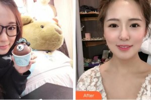 黃石現(xiàn)代口腔醫(yī)院陳琪整形價(jià)格表附美白貼片案例展示