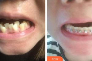 黃石春天口腔門(mén)診部陳炳軍整形價(jià)格表附金屬托槽矯正案例展示