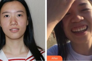 黃石春天口腔門(mén)診部孫楚春整形價(jià)格表附牙貼面案例展示