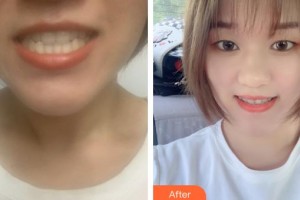 黃石春天口腔門(mén)診部宮小成整形價(jià)格表附牙齒隱形矯正案例展示