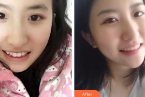 黃石春天口腔門(mén)診部劉春林整形價(jià)格表附牙齒隱形矯正案例展示