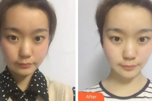 十堰市婦幼保健院整形美容中心陳紅梅整形價格表附埋線提升案例展示