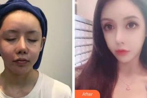 十堰東風總醫(yī)院整形激光美容科郝瑜整形價格表附熱瑪吉案例展示