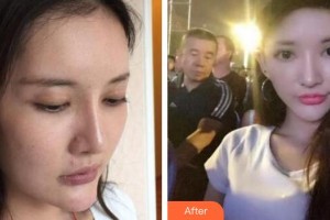 十堰市人民醫(yī)院整形美容燒傷外科王建國(guó)整形價(jià)格表附埋線(xiàn)提升案例展示