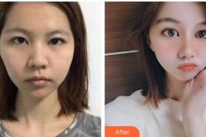 十堰愛(ài)爾眼科醫(yī)院張青松整形價(jià)格表附熱拉提案例展示