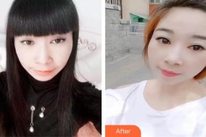 十堰愛(ài)爾眼科醫(yī)院李凌整形價(jià)格表附切眉術(shù)案例展示