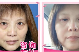 十堰愛爾眼科醫(yī)院鄭瑞整形價格表附激光去眼袋案例展示