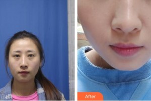 十堰愛(ài)爾眼科醫(yī)院李儒華整形價(jià)格表附切開(kāi)雙眼皮案例展示