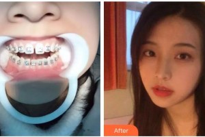 十堰東風(fēng)口腔醫(yī)院董紅整形價(jià)格表附隱形托槽矯正案例展示