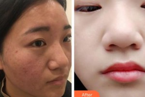 襄陽韓美醫(yī)療美容醫(yī)院王娜整形價(jià)格表附去痘印痘坑案例展示