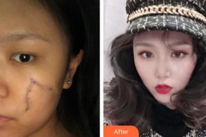 襄陽市中心醫(yī)院整形美容科劉丹丹整形價(jià)格表附光子嫩膚案例展示