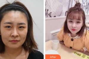 襄陽市中心醫(yī)院整形美容科惠祖燕整形價(jià)格表附彩光嫩膚案例展示