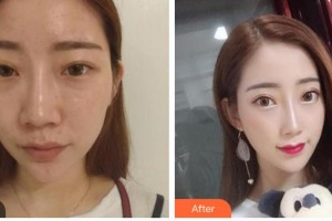 襄陽維多利亞醫(yī)療美容醫(yī)院洪星杓整形價(jià)格表附鼻部綜合案例展示