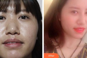 襄陽華美醫(yī)療美容門診部段麗萍整形價(jià)格表附鼻部綜合案例展示