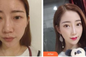 襄陽華美醫(yī)療美容門診部張輝整形價(jià)格表附假體隆鼻案例展示