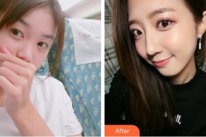 襄陽德爾美客西子醫(yī)療整形美容門診部黃亮誼整形價格表附硅膠隆鼻案例展示