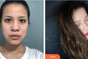 襄陽維多利亞醫(yī)療美容醫(yī)院端丹整形價(jià)格表附鼻部綜合案例展示