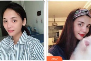 襄陽伊爾美整形美容醫(yī)院楊勤整形價格表附自體脂肪豐面頰案例展示