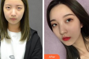 襄陽漢辰醫(yī)療美容門診部劉俊慧整形價格表附自體脂肪全臉填充案例展示