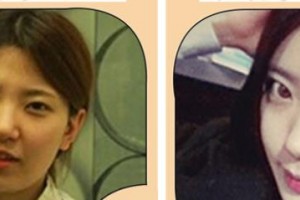 襄陽悅美醫(yī)療美容門診部段杰整形價格表附自體脂肪全臉填充案例展示