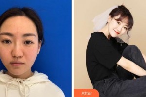 襄陽韓蔻醫(yī)療美容門診部王健強整形價格表附熱瑪吉案例展示