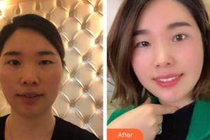 襄陽韓蔻醫(yī)療美容門診部劉永盛整形價格表附熱瑪吉案例展示