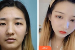 襄陽愛爾眼科醫(yī)院李卓君整形價格表附眼部綜合案例展示