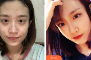 襄陽愛爾眼科醫(yī)院肖明整形價格表附眼部綜合案例展示