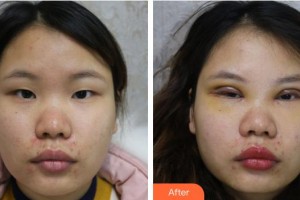 襄陽愛爾眼科醫(yī)院呂雪婷整形價格表附眼部綜合案例展示